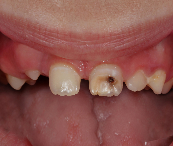 before